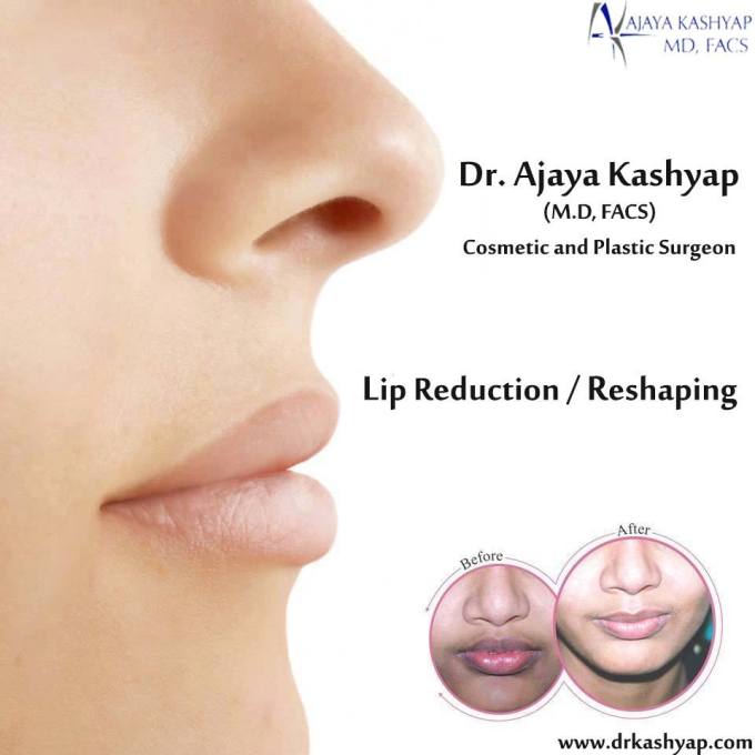 #lipreduction, lip reduction cosmetic surgery, lip reduction surgery, lip reduction cost, lip reduction surgeon, lip surgery clinic, #southdelhi, #lipsurgerycost